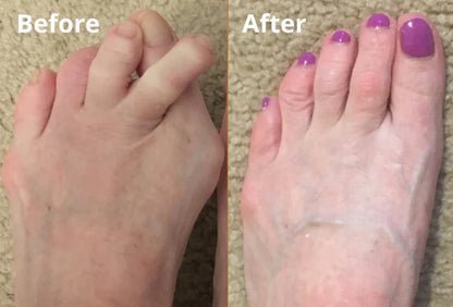 Alowat Hammered Toes Corrector